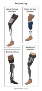 Contoh prostesis kaki untuk berbagai tingkat amputasi