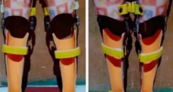 Cara Kerja KAFO Sebagai Alat Bantu Jalan