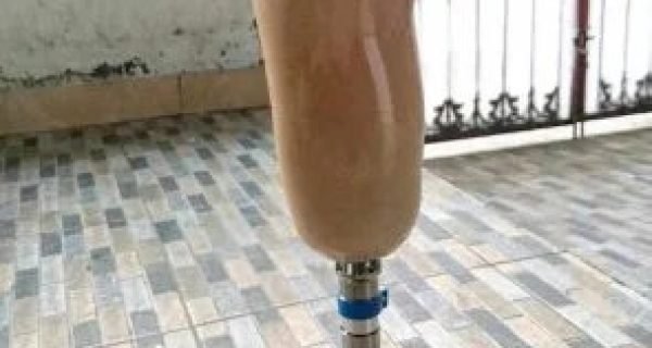 cara kerja kaki palsu bionik
